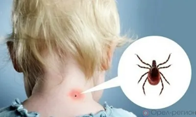 От укуса клещей пострадали почти 400 орловцев
